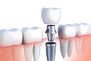 相武台、座間・相武台セントラル歯科・STEP5